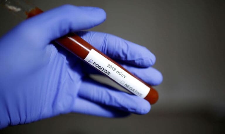 Jardim Alegre registra quatro novos casos de Covid-19 na segunda (1º)