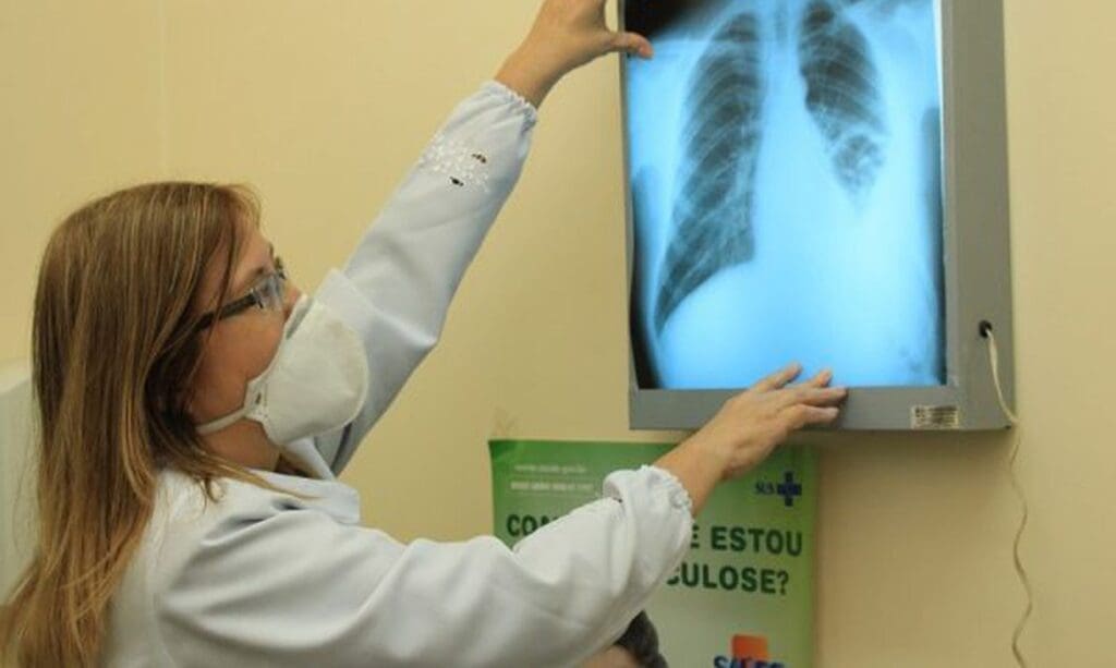 Tuberculose: importância do diagnóstico e tratamento