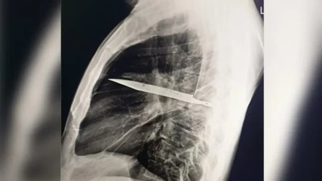 A lâmina estava presa ao lado direito do tórax, encostada à escápula/Foto: Reprodução