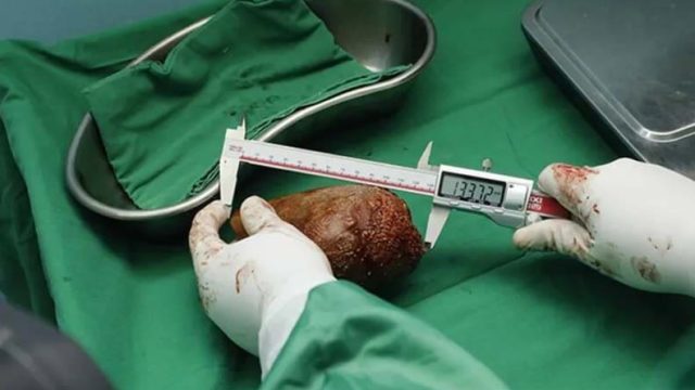 Maior pedra no rim do mundo — Foto: Exército do Sri Lanka