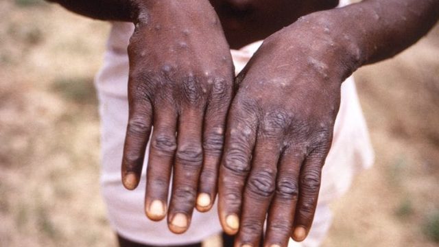 Varíola dos macacos