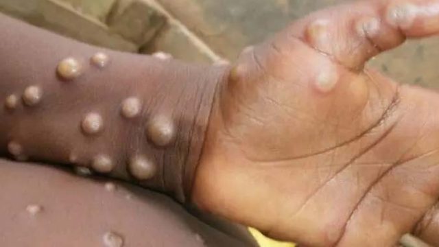 variola-macaco-28052022 váriola dos macacos